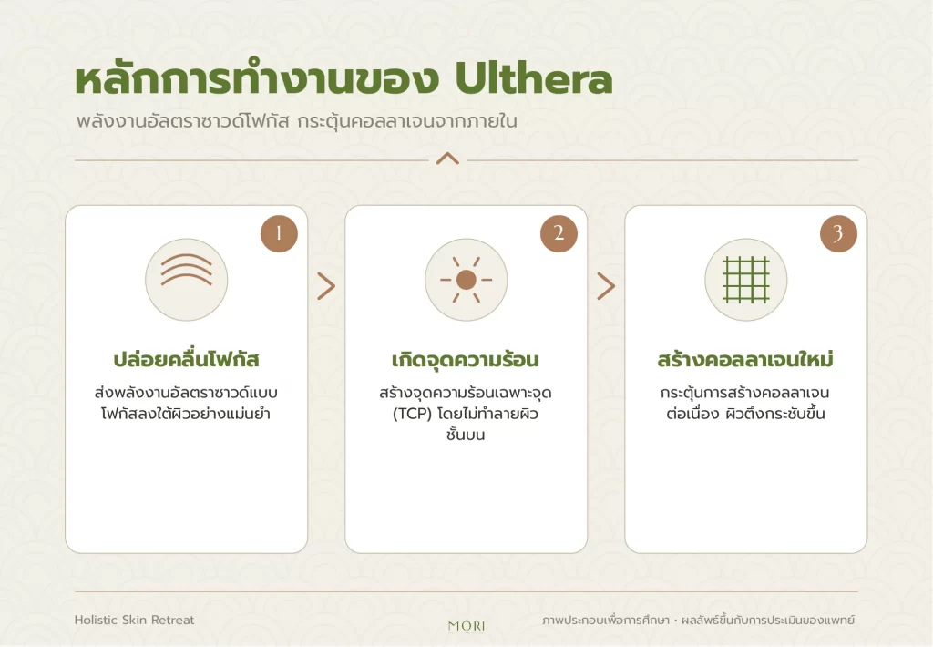 Ulthera-หลักการทำงาน