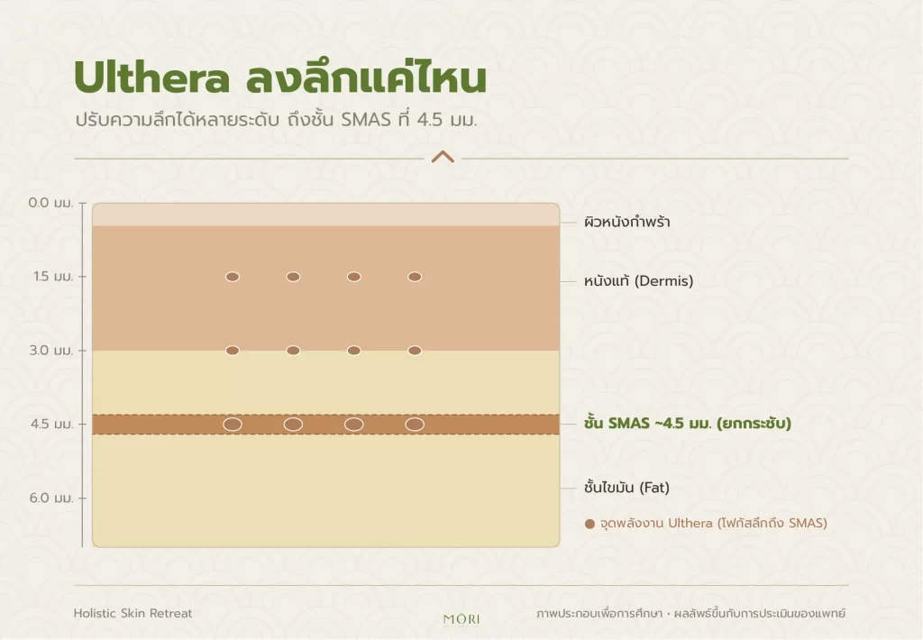 Ulthera-ความลึกชั้นผิว