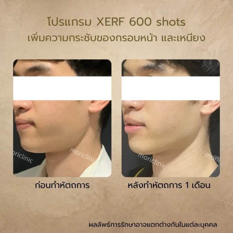 รีวิว XERF 600 shots ก่อนและหลังรักษา Mori Clinic