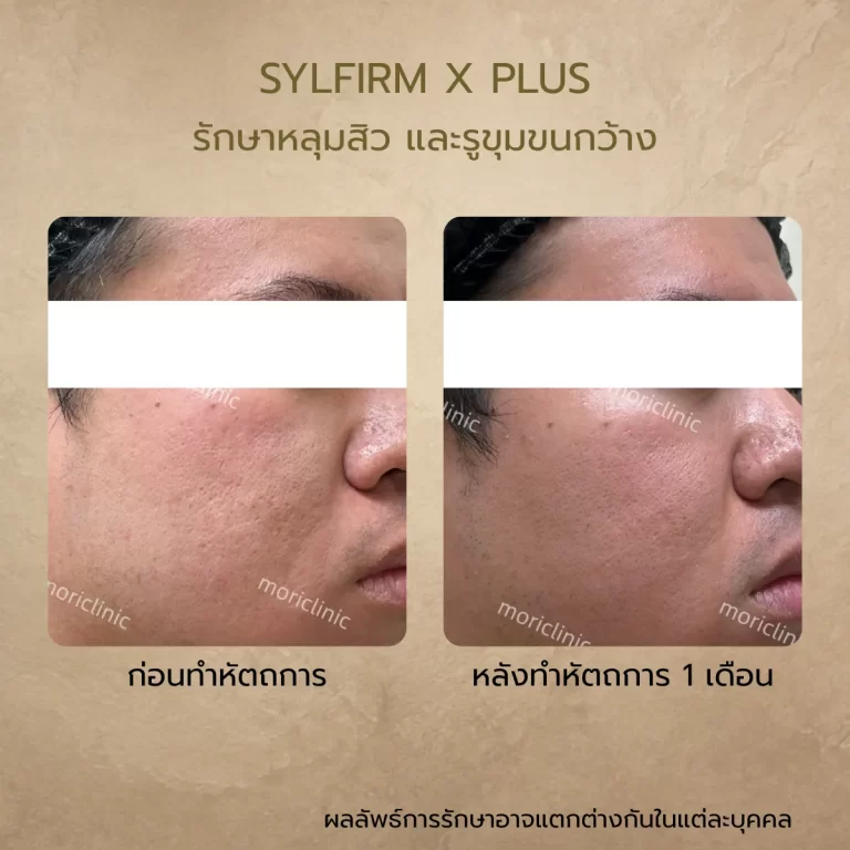 รีวิว Sylfirm X Plus ก่อนและหลังรักษา Mori Clinic