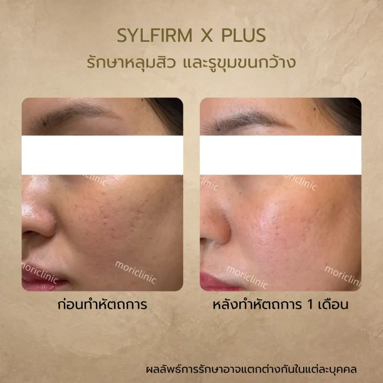 รีวิว Sylfirm X Plus ก่อนและหลังรักษา Mori Clinic