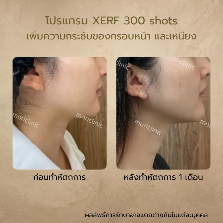 รีวิว XERF 300 shots ก่อนและหลังรักษา Mori Clinic