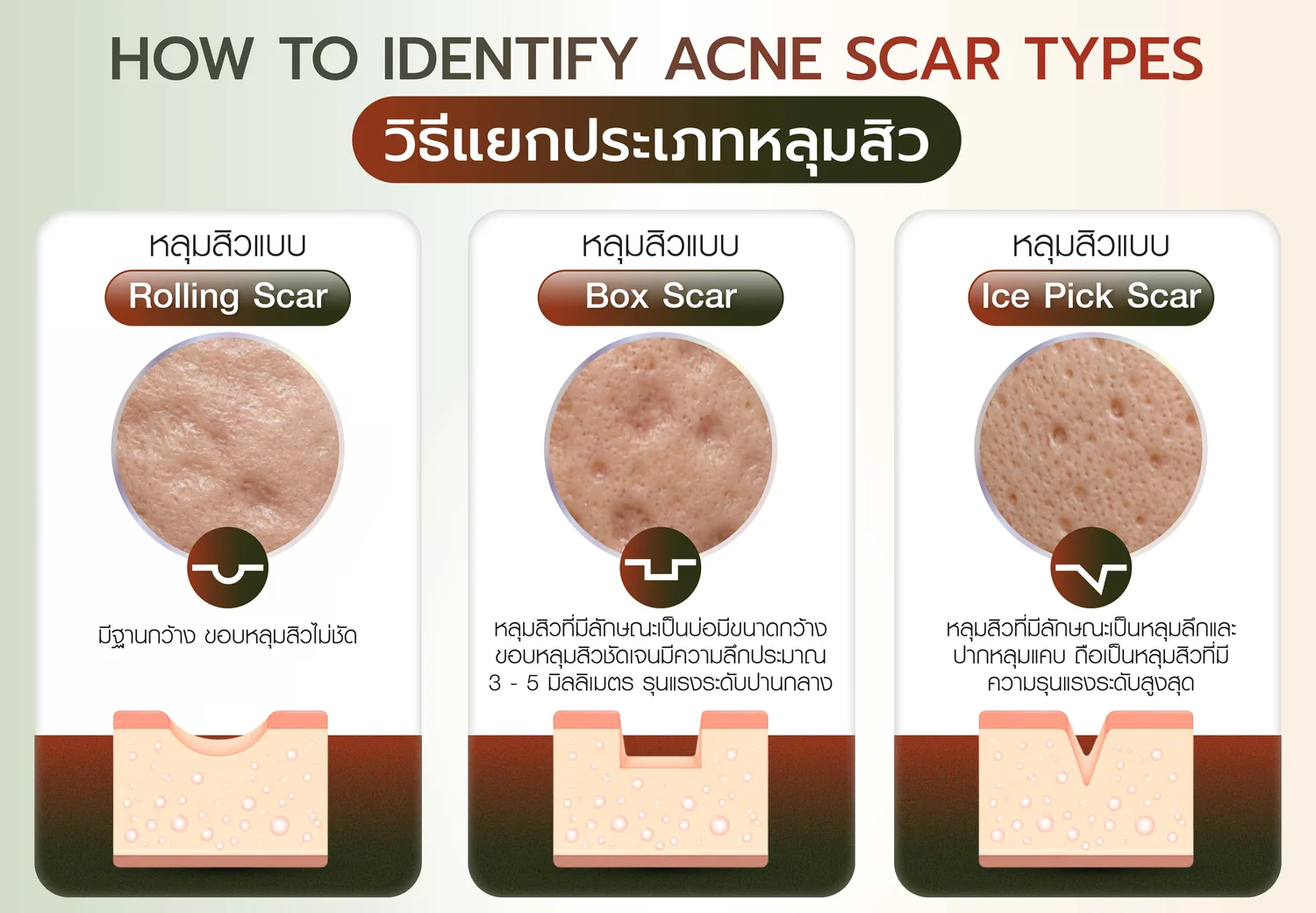 ประเภทหลุมสิว Rolling Boxcar Ice pick
