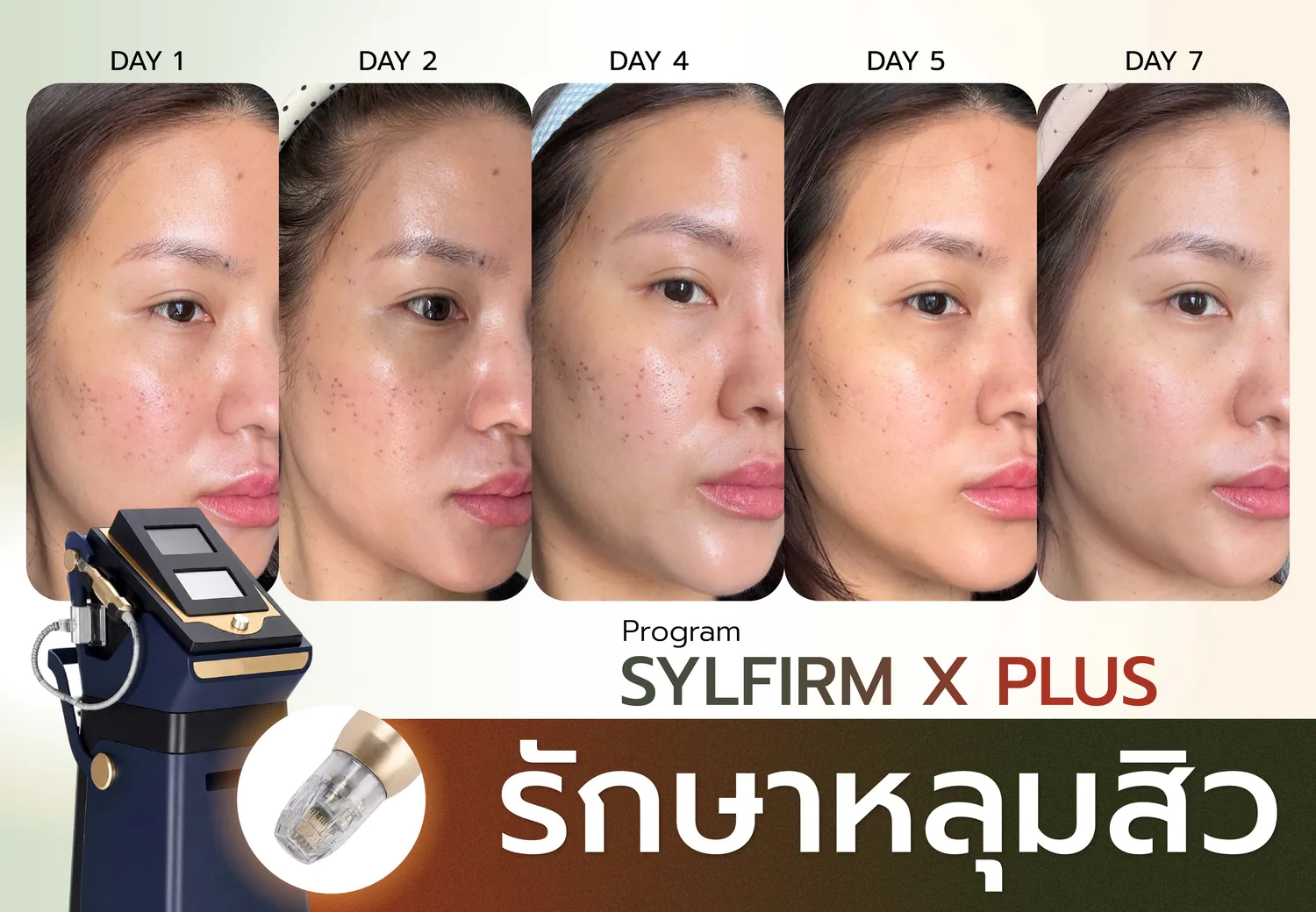 Sylfirm X Plus รักษาหลุมสิว Mori Clinic